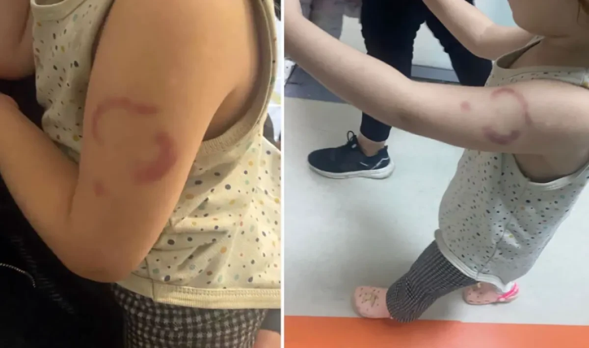 Edirne’de Kreşte Skandal İddia: 3 Yaşındaki Çocuğu Öğretmeni Isırdı!