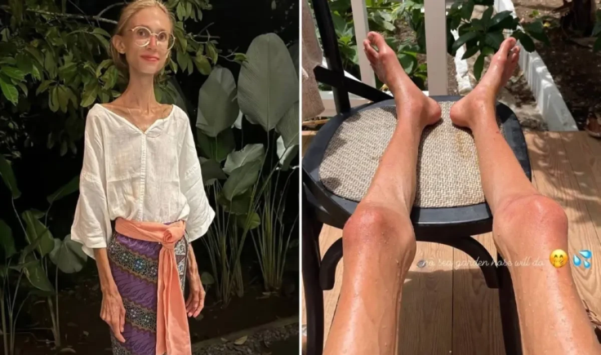 Meyve Diyetiyle 20 Kilo Verdiğini İddia Etti: Sosyal Medya Çalkalandı